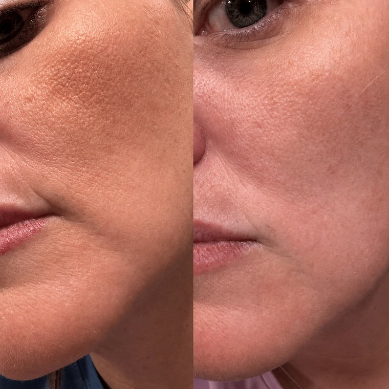 Julliet before and after